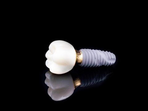 Tipuri de Implanturi Dentare