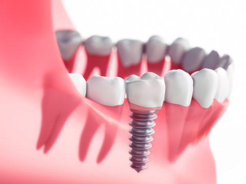 Recuperare după implant dentar – indicații și recomandări