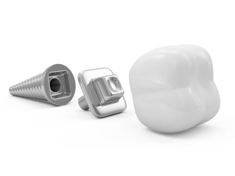 Implant dentar componente: implant, bont, coroana