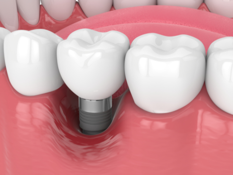Periimplantita: cauze, simptome, tratament