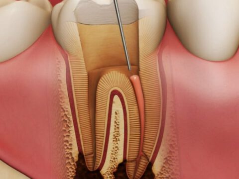 Endodonție